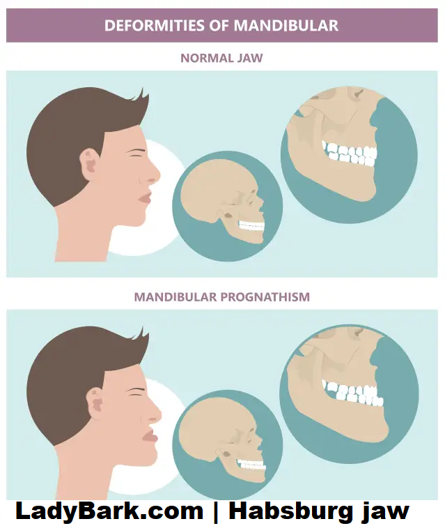 Habsburg jaw